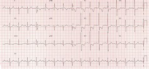 signs of rvh on ekg.